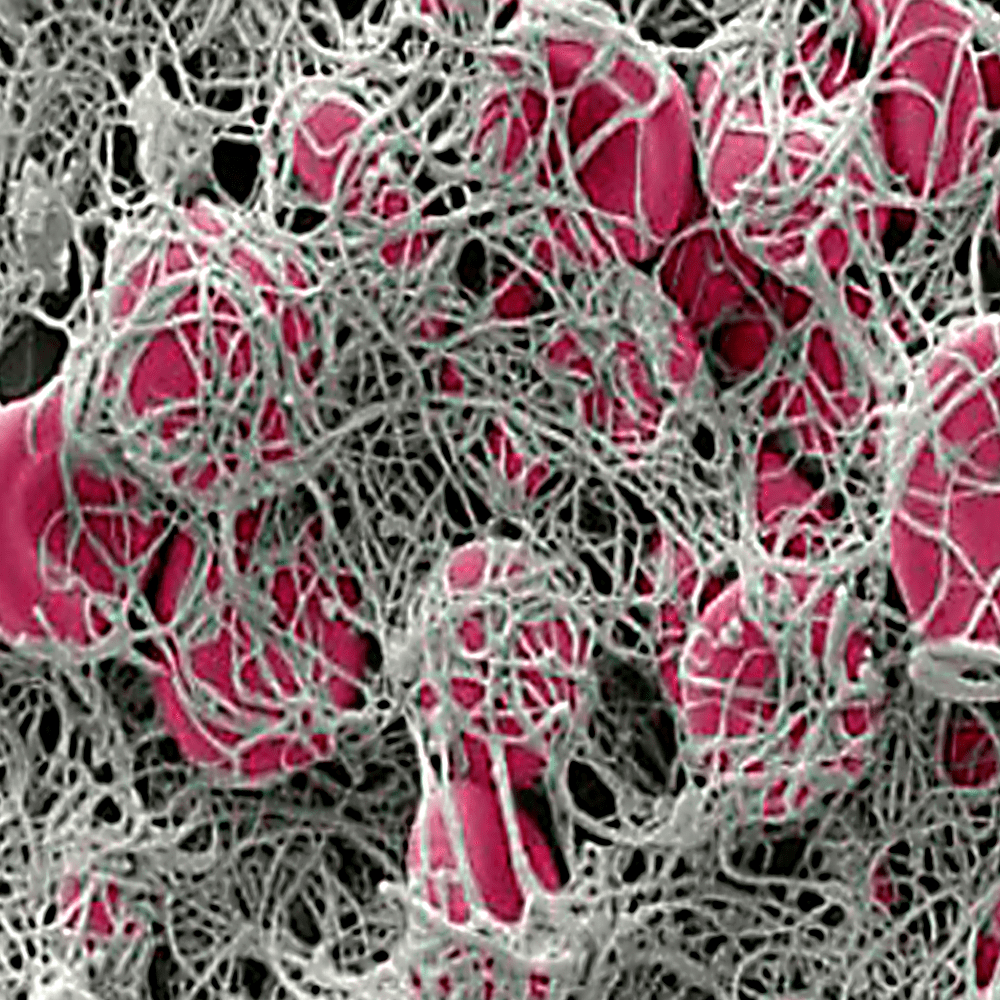 Fibrin strands in a blood clot