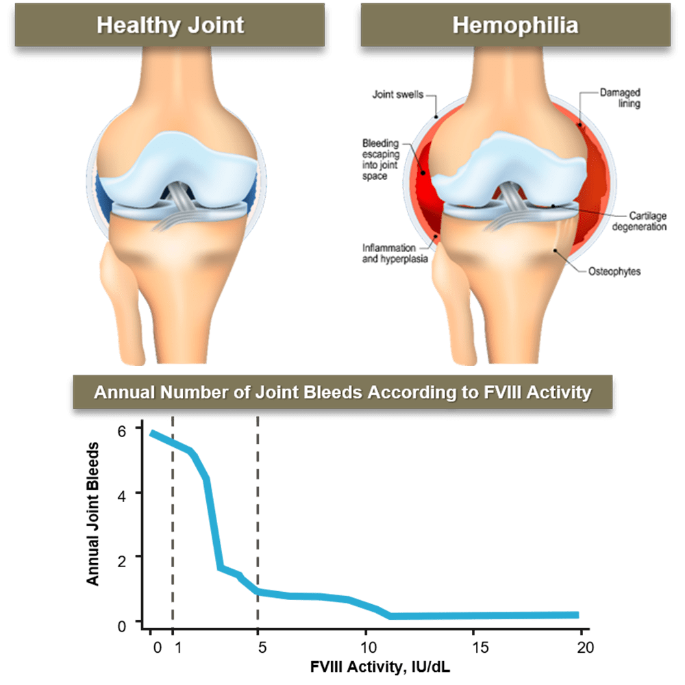 Images of healthy joints and then joints that are affected by having Hemophilia, and a chart that shows the annual number of joint bleeds adcording to FVIII activity 